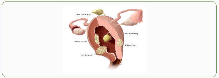 What is the treatment for ovarian fibroids?